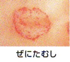 ぜにたむし